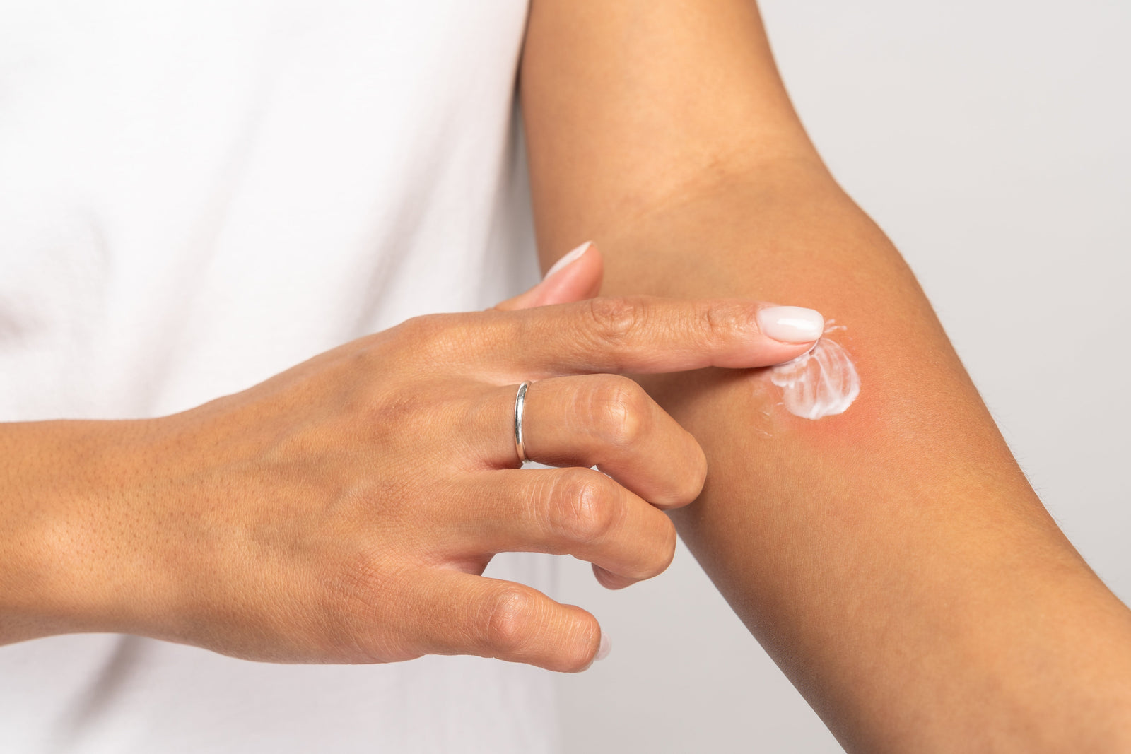CBD Topicals for Better Skin Health: Eczema, Psoriasis, and Dry Skin